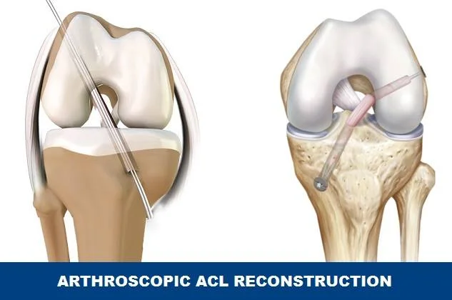 ACL Reconstruction Surgery