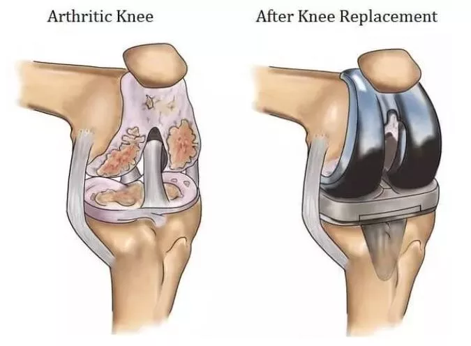 knee-replacement-arthroscopy-surgery
