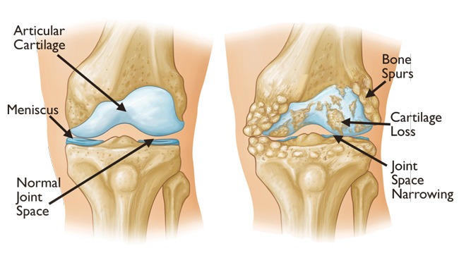 Knee Replacement or Stem Cell Therapy