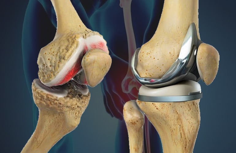 joint replacement surgery