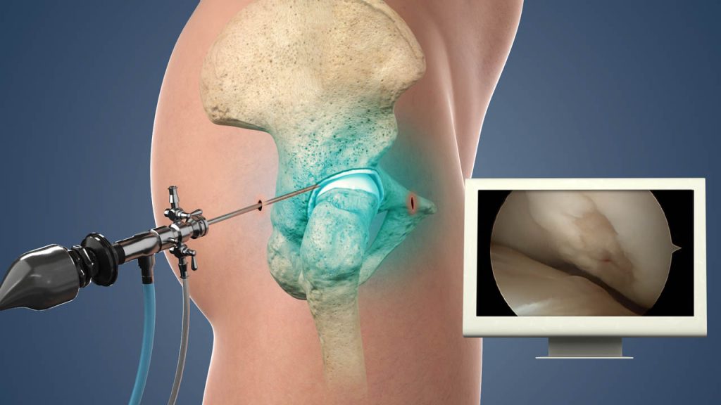 Arthroscopic Surgery