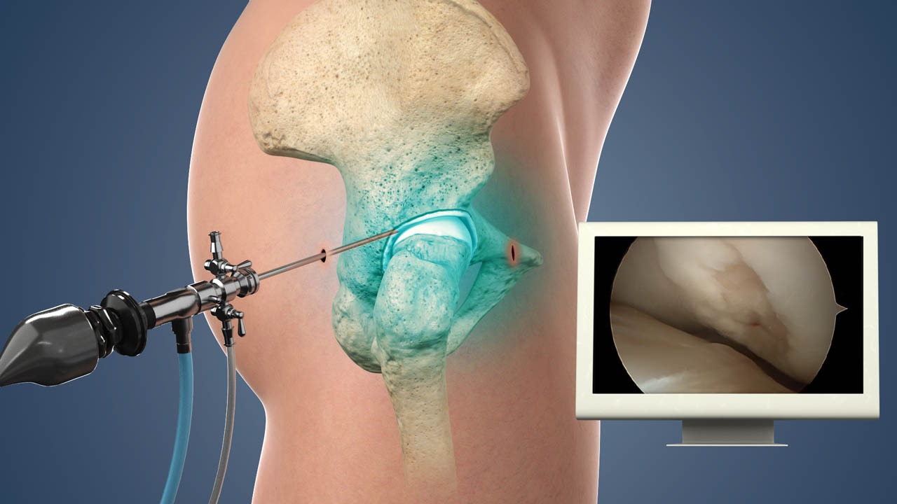 Arthroscopic Surgery
