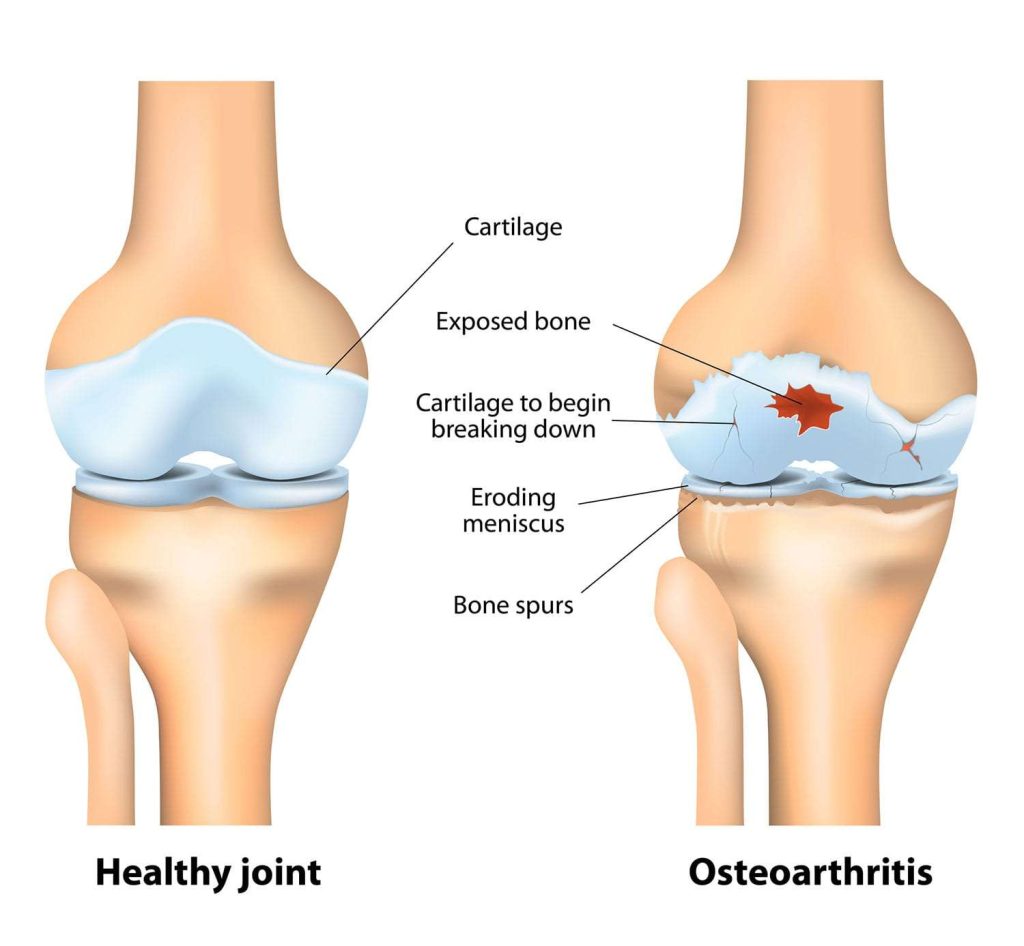 Osteoarthritis